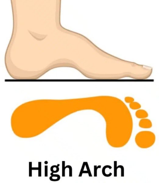 pieds à arc élevé